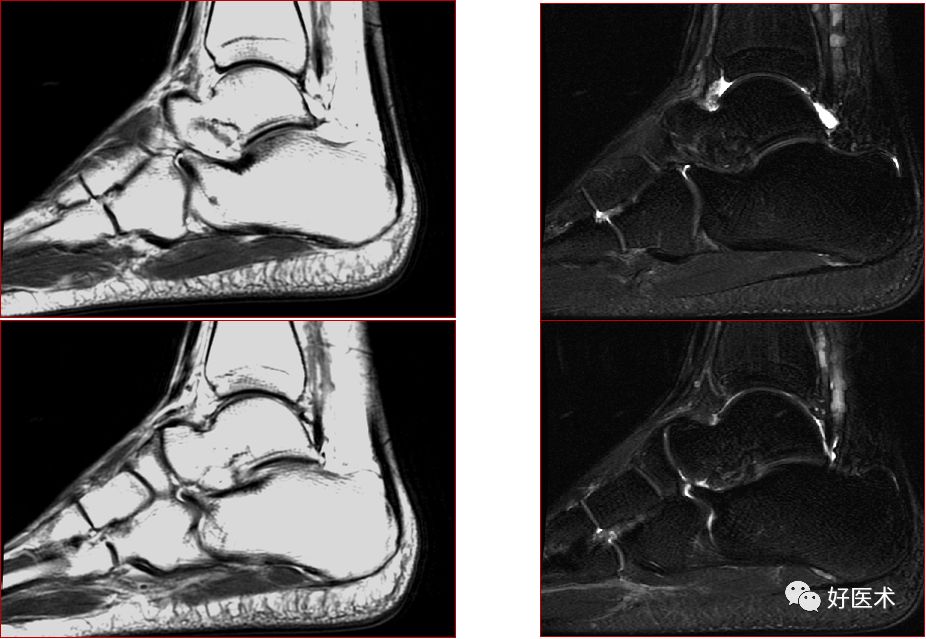 踝关节MRI解剖与常见病变-52