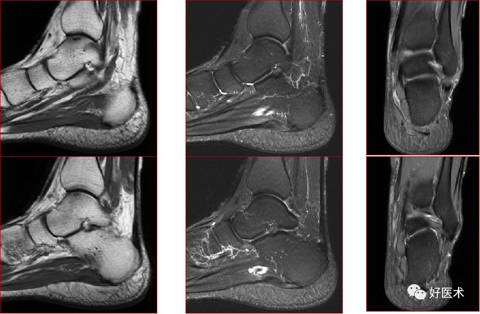 踝关节MRI解剖与常见病变-53