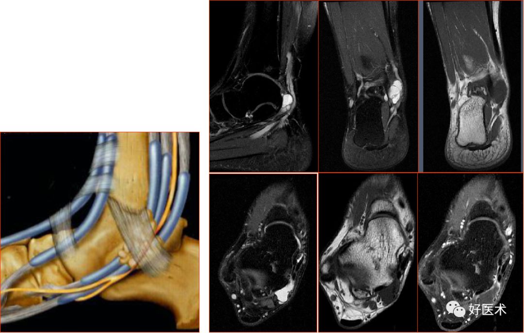 踝关节MRI解剖与常见病变-55