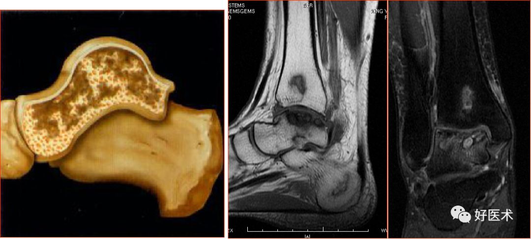 踝关节MRI解剖与常见病变-56