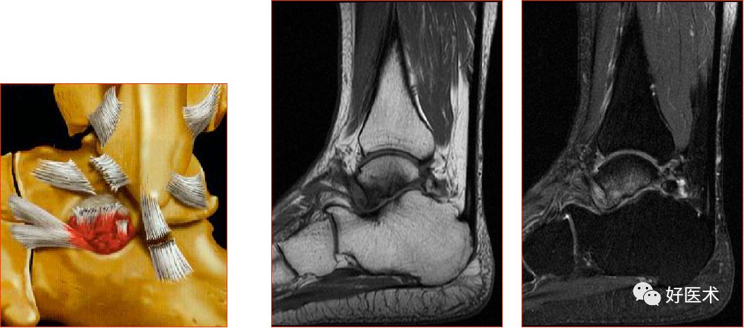 踝关节MRI解剖与常见病变-57