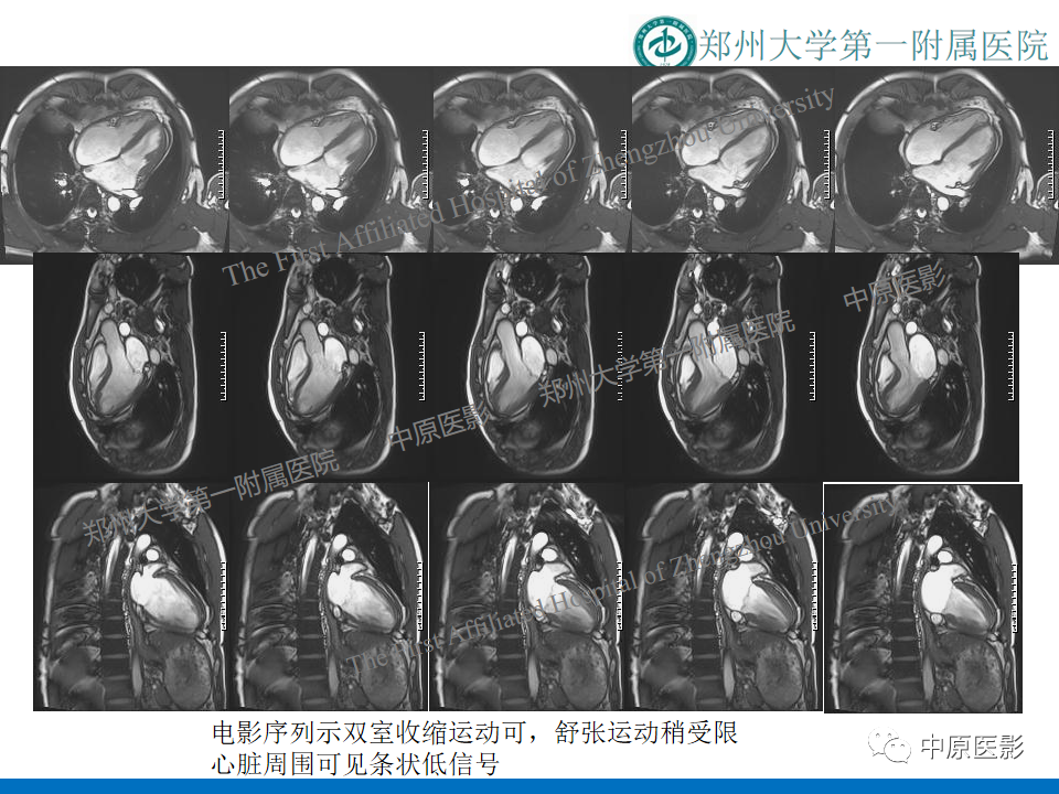 【病例】缩窄性心包炎1例MR影像-4