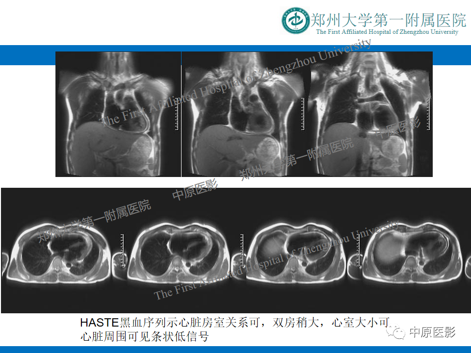 【病例】缩窄性心包炎1例MR影像-3