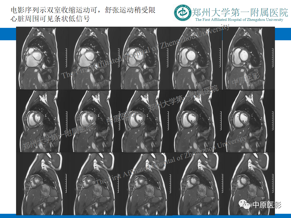 【病例】缩窄性心包炎1例MR影像-5