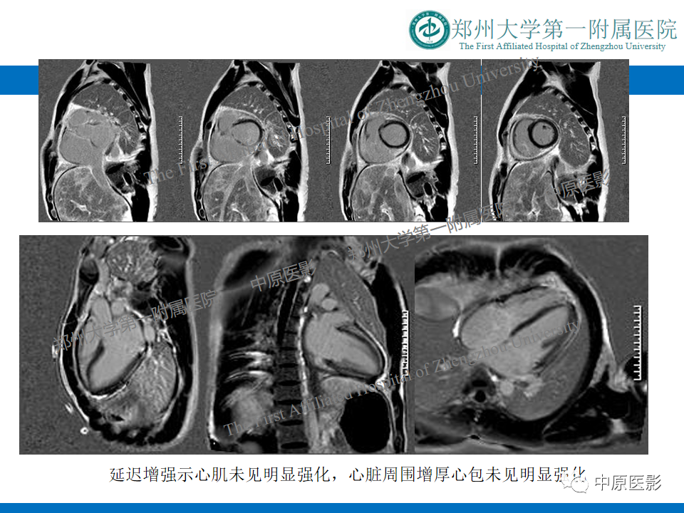 【病例】缩窄性心包炎1例MR影像-7