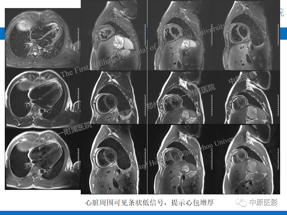 【病例】缩窄性心包炎1例MR影像-6
