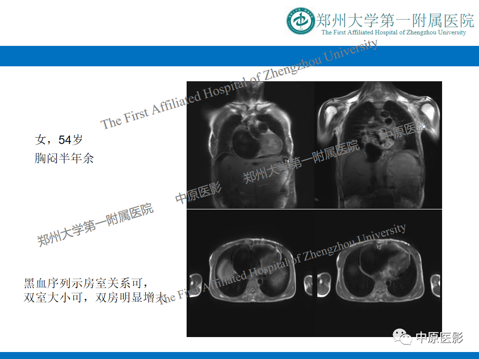 【病例】缩窄性心包炎1例MR影像-16