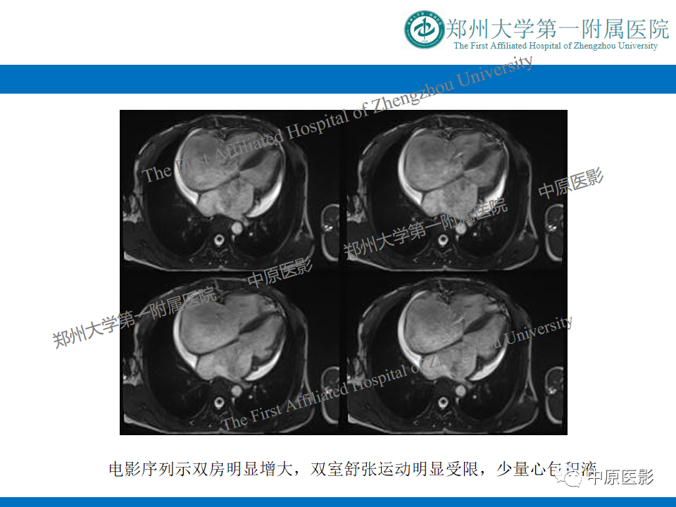 【病例】缩窄性心包炎1例MR影像-17