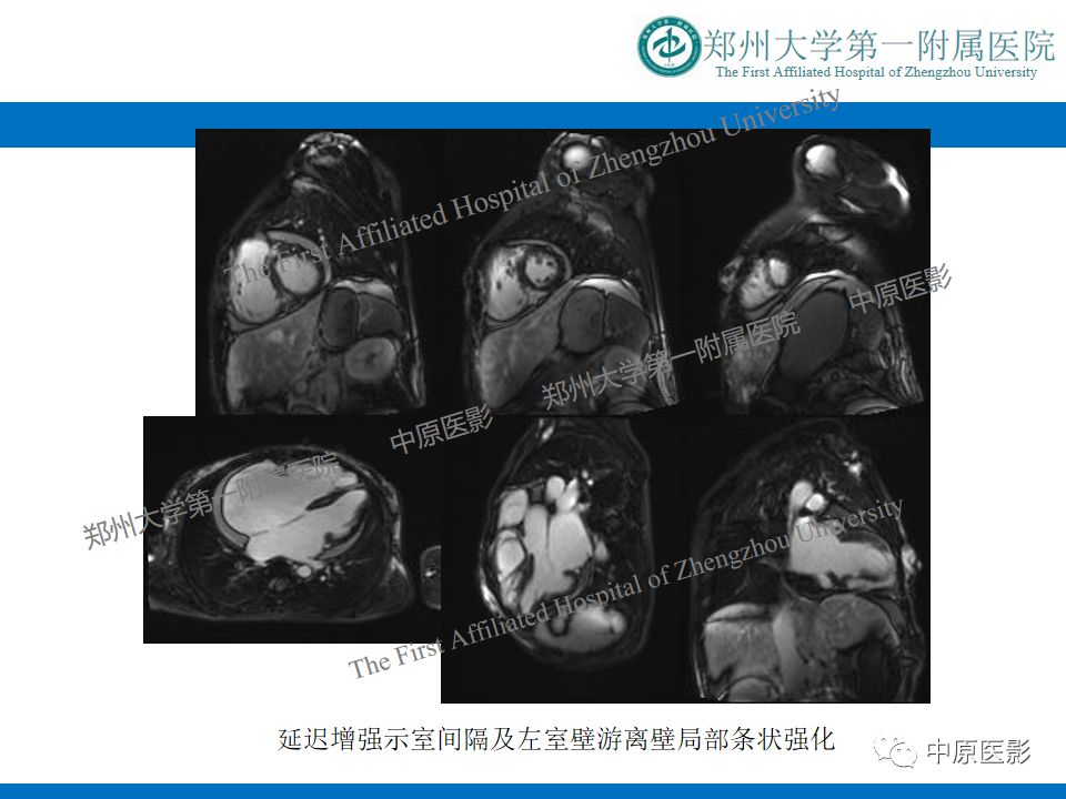 【病例】缩窄性心包炎1例MR影像-18
