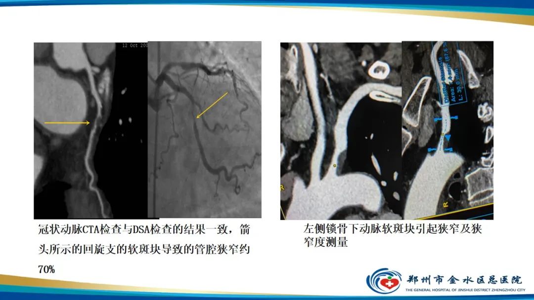 【PPT】冠脉头颈一站式CTA联合扫描技术-6