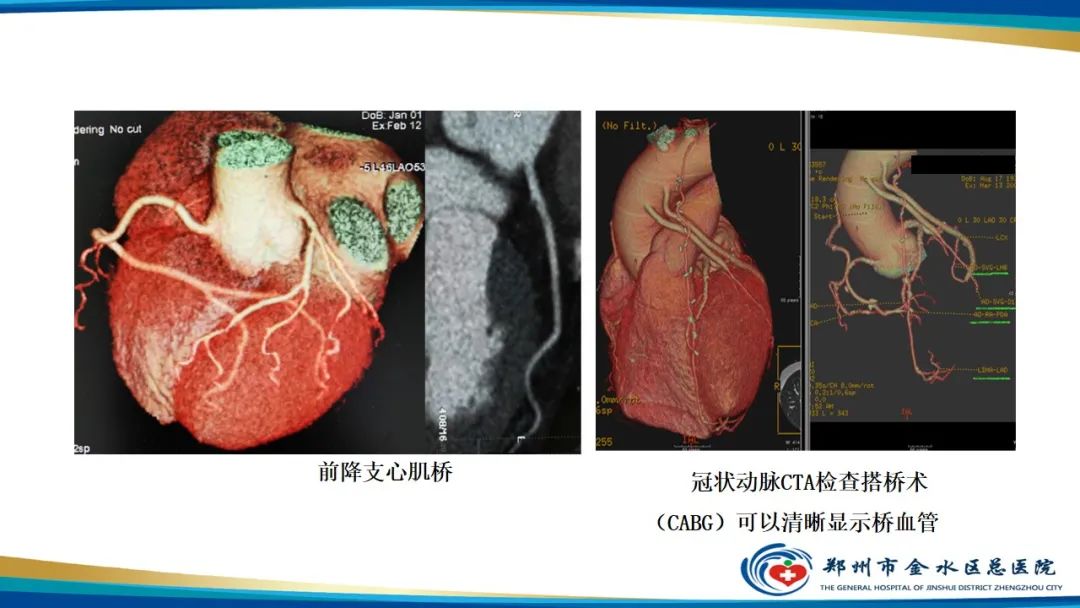 【PPT】冠脉头颈一站式CTA联合扫描技术-8