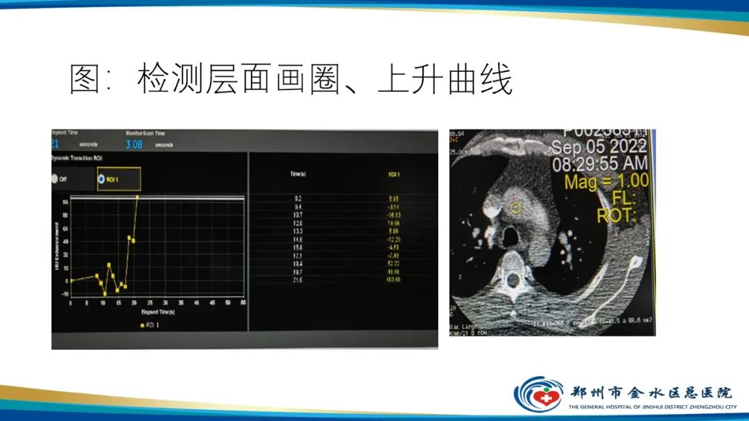 【PPT】冠脉头颈一站式CTA联合扫描技术-24