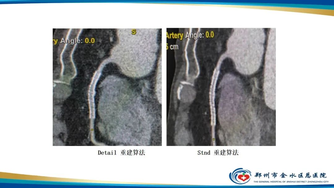 【PPT】冠脉头颈一站式CTA联合扫描技术-27