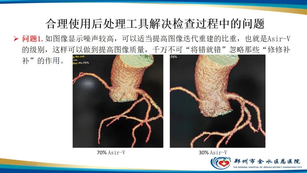 【PPT】冠脉头颈一站式CTA联合扫描技术-28