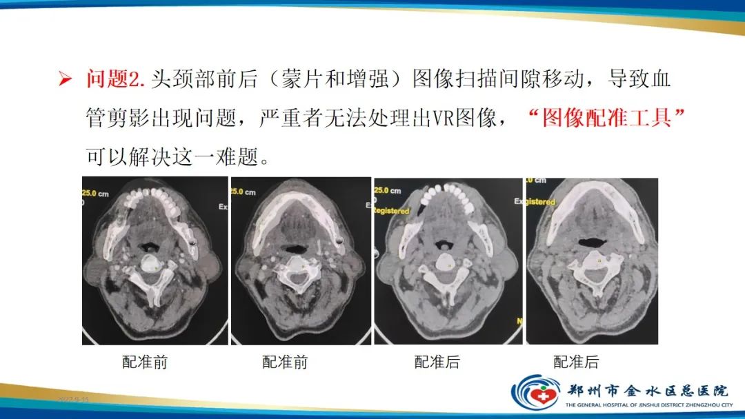 【PPT】冠脉头颈一站式CTA联合扫描技术-29