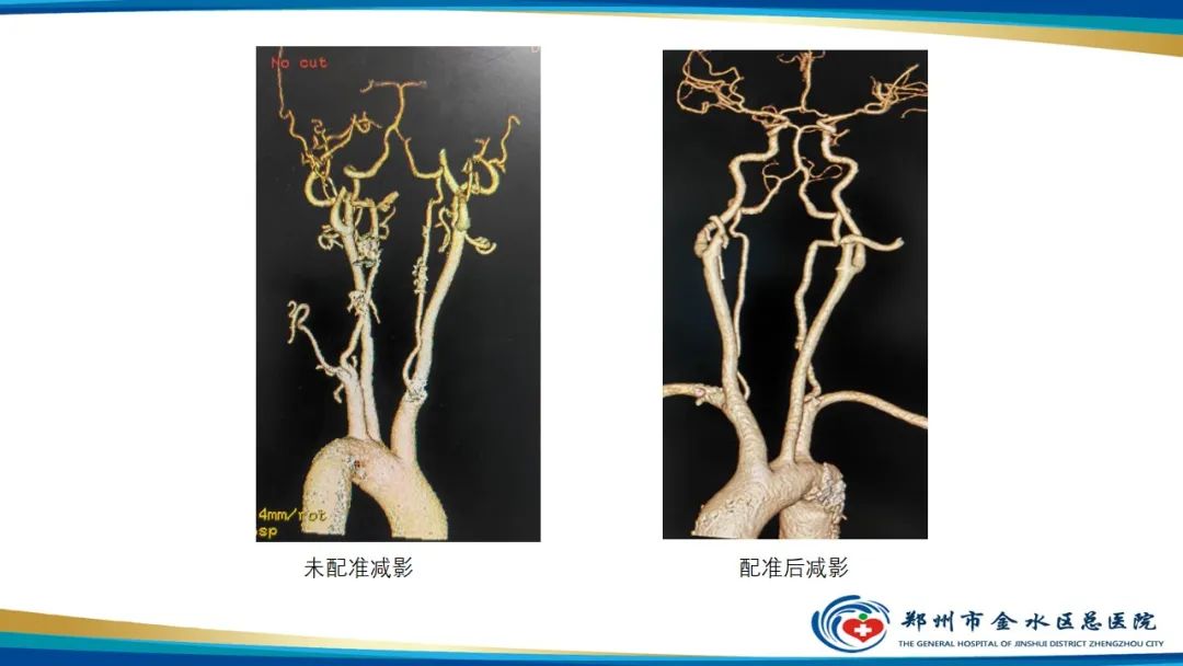 【PPT】冠脉头颈一站式CTA联合扫描技术-30