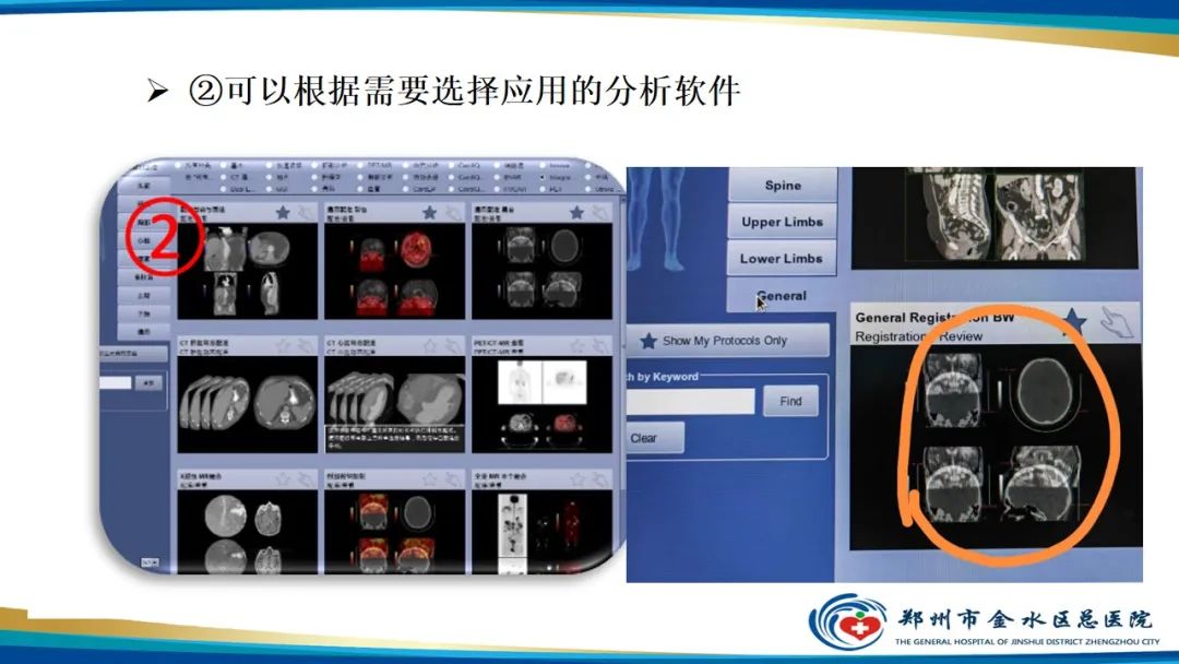 【PPT】冠脉头颈一站式CTA联合扫描技术-32