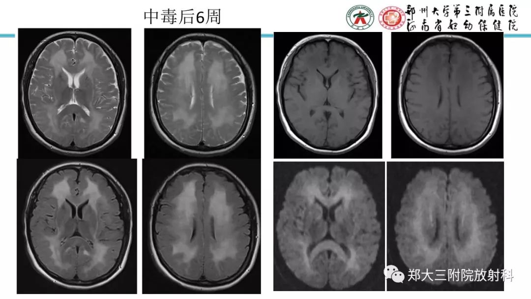 【PPT】中毒性脑病影像学诊断-12