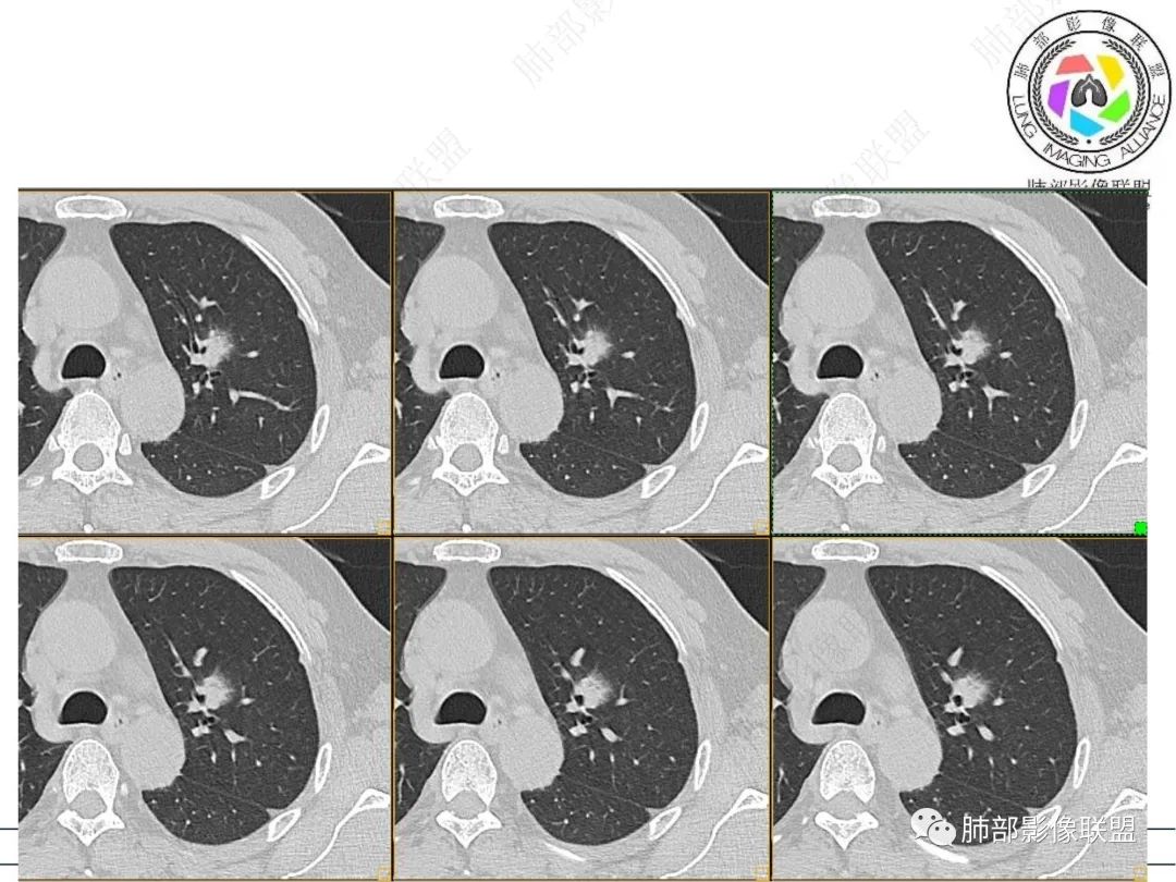 【病例】三年逐渐增大的混合磨玻璃结节，真相是什么？-7