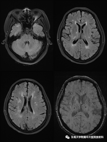 【PPT】伴有皮质下梗死和白质脑病的常染色体显性遗传性脑动脉病(CADASIL)-1