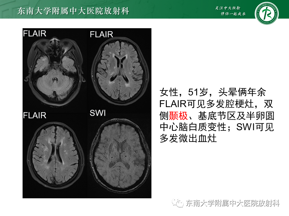 【PPT】伴有皮质下梗死和白质脑病的常染色体显性遗传性脑动脉病(CADASIL)-2