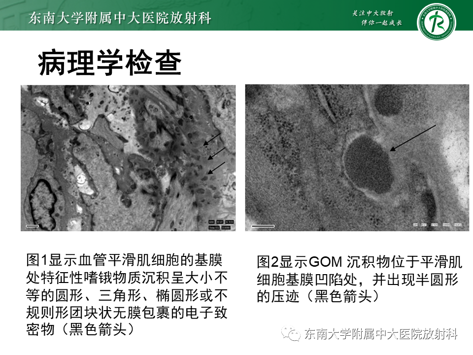 【PPT】伴有皮质下梗死和白质脑病的常染色体显性遗传性脑动脉病(CADASIL)-8