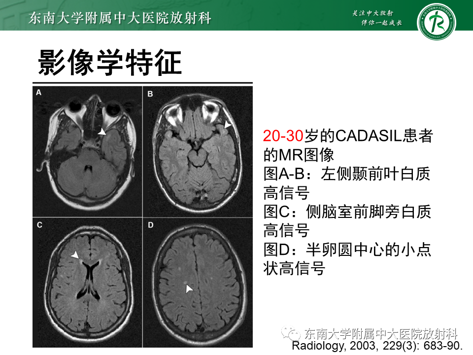 【PPT】伴有皮质下梗死和白质脑病的常染色体显性遗传性脑动脉病(CADASIL)-14