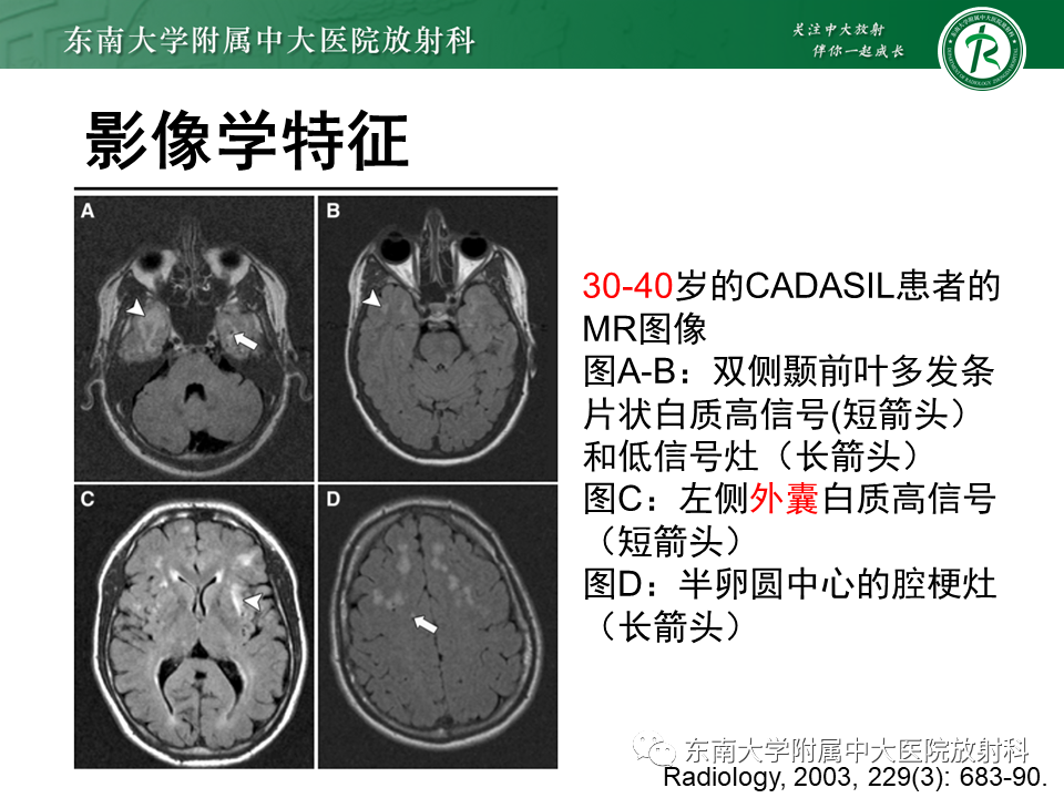 【PPT】伴有皮质下梗死和白质脑病的常染色体显性遗传性脑动脉病(CADASIL)-15