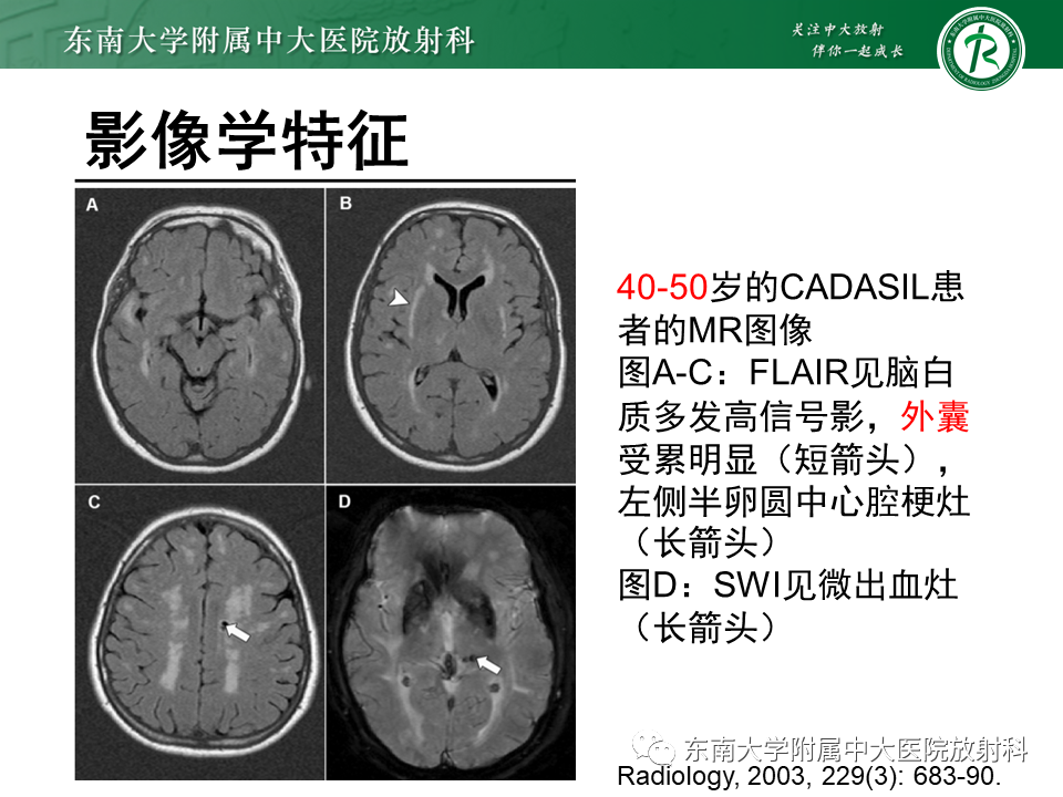 【PPT】伴有皮质下梗死和白质脑病的常染色体显性遗传性脑动脉病(CADASIL)-16