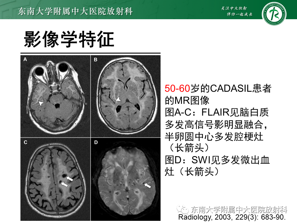 【PPT】伴有皮质下梗死和白质脑病的常染色体显性遗传性脑动脉病(CADASIL)-17