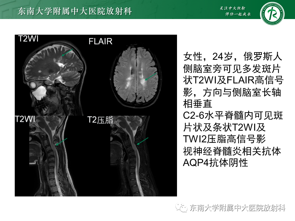 【PPT】伴有皮质下梗死和白质脑病的常染色体显性遗传性脑动脉病(CADASIL)-24