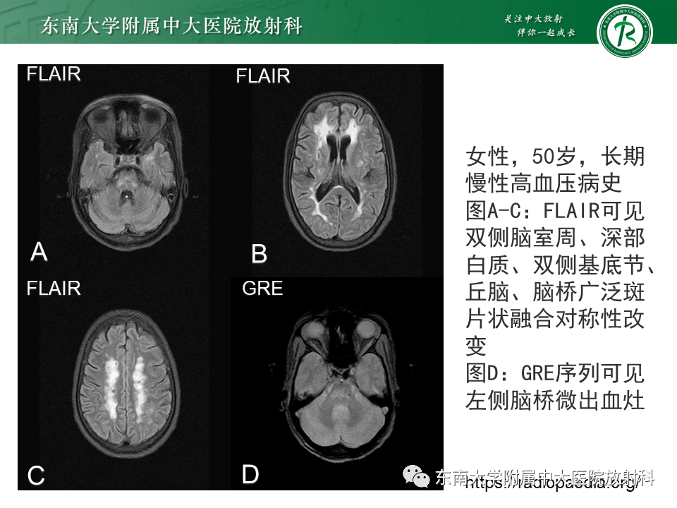 【PPT】伴有皮质下梗死和白质脑病的常染色体显性遗传性脑动脉病(CADASIL)-26