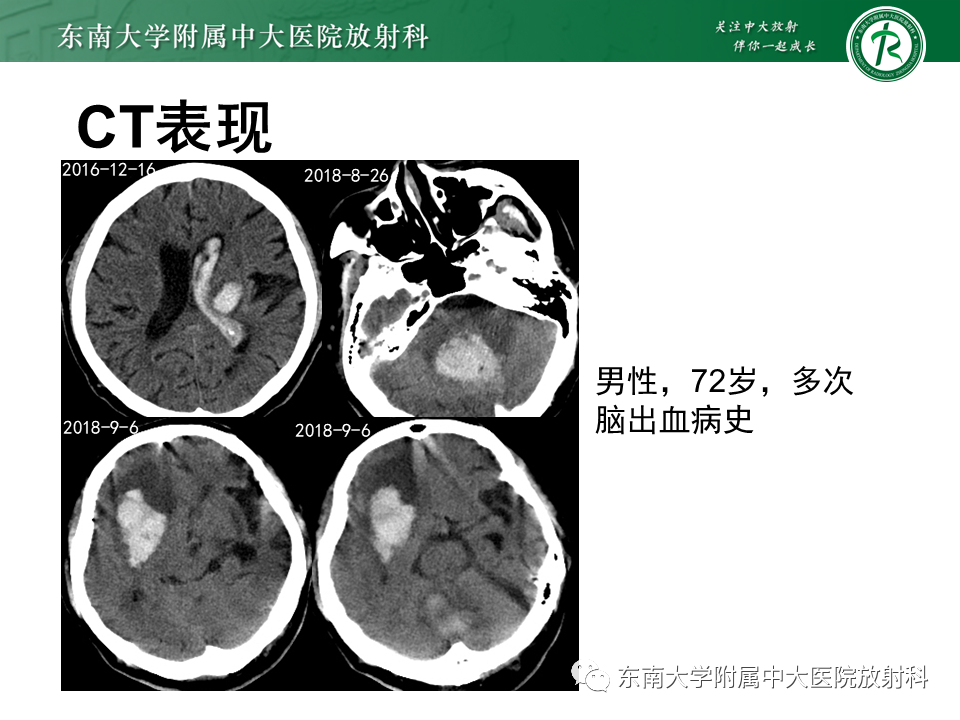 【PPT】伴有皮质下梗死和白质脑病的常染色体显性遗传性脑动脉病(CADASIL)-29