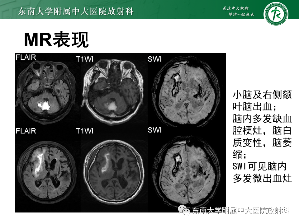 【PPT】伴有皮质下梗死和白质脑病的常染色体显性遗传性脑动脉病(CADASIL)-30