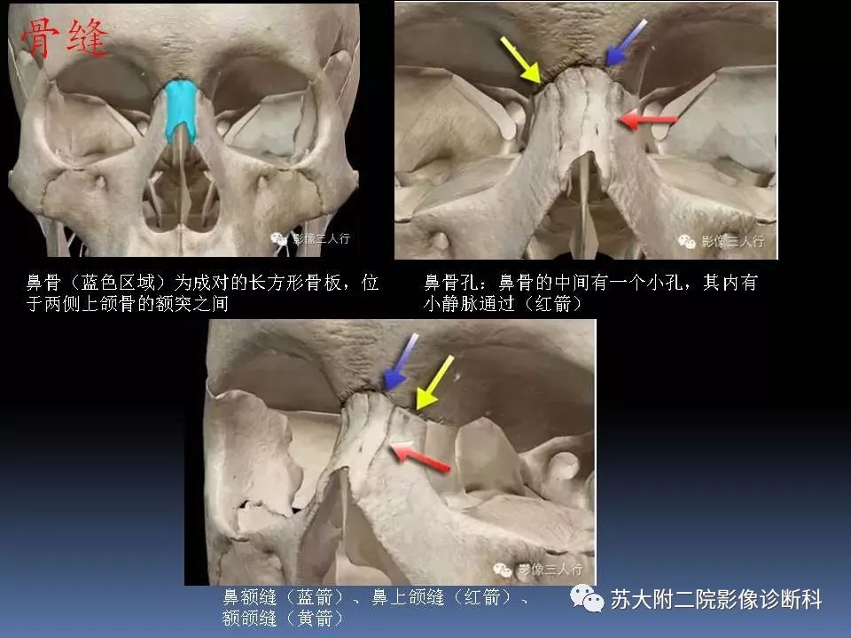 【PPT】鼻骨骨折影像诊断误区-5