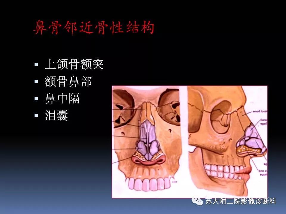 【PPT】鼻骨骨折影像诊断误区-4