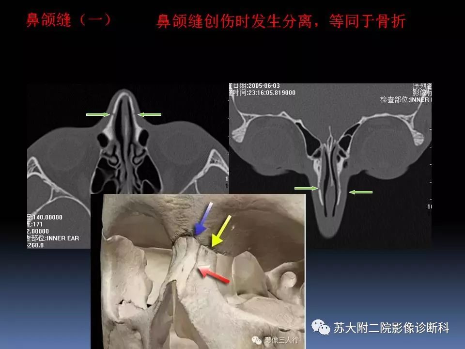 【PPT】鼻骨骨折影像诊断误区-6