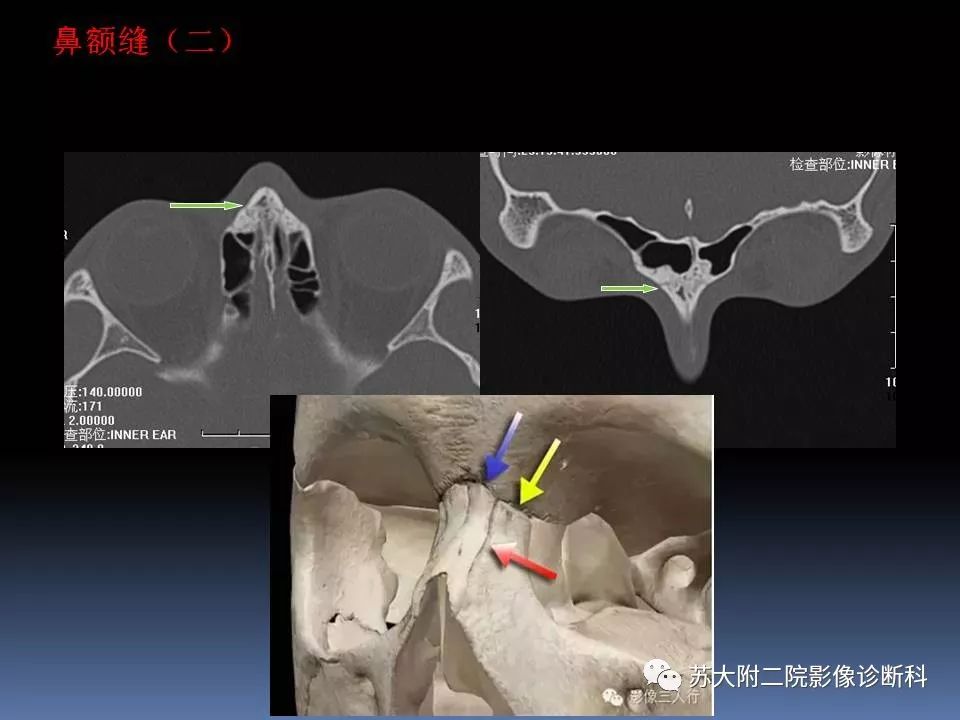 【PPT】鼻骨骨折影像诊断误区-7