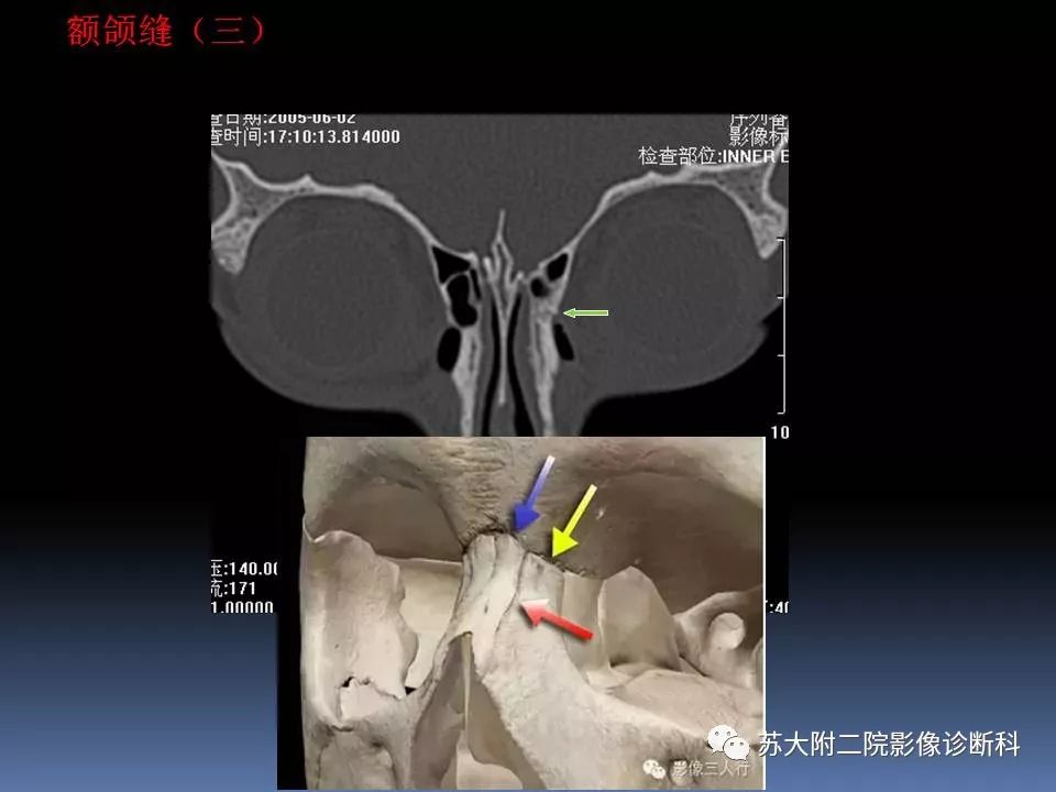 【PPT】鼻骨骨折影像诊断误区-8