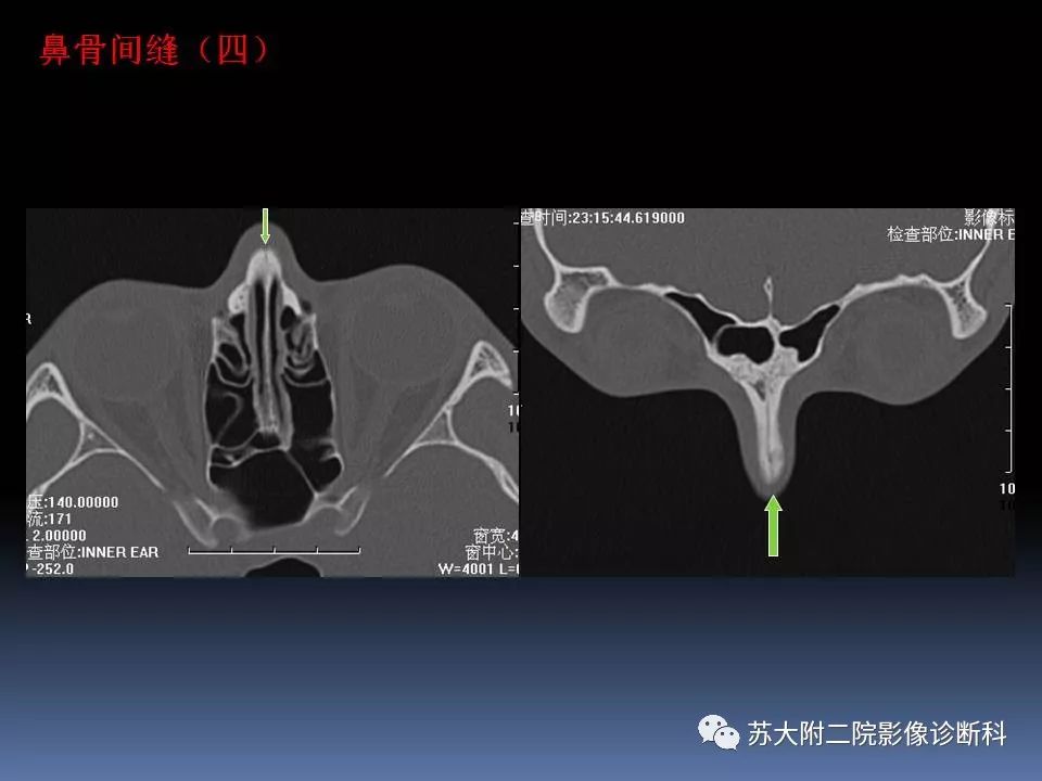 【PPT】鼻骨骨折影像诊断误区-9