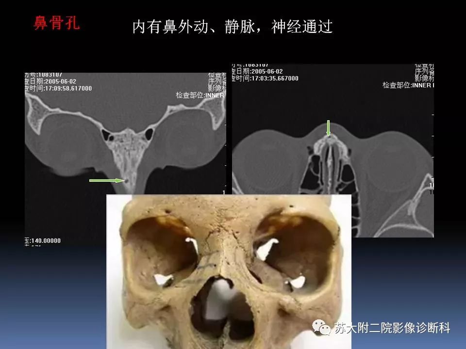 【PPT】鼻骨骨折影像诊断误区-10
