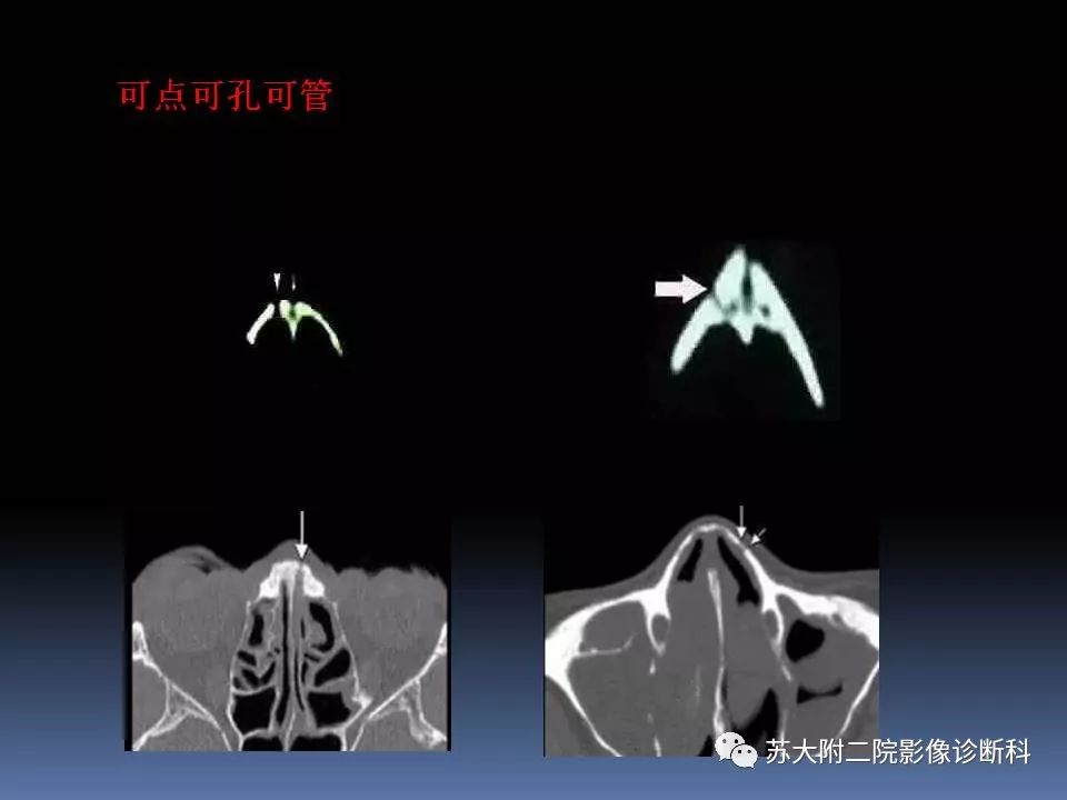 【PPT】鼻骨骨折影像诊断误区-11