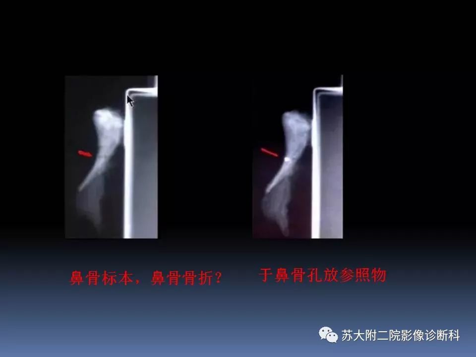 【PPT】鼻骨骨折影像诊断误区-12