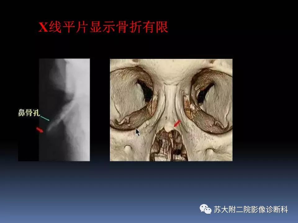 【PPT】鼻骨骨折影像诊断误区-17