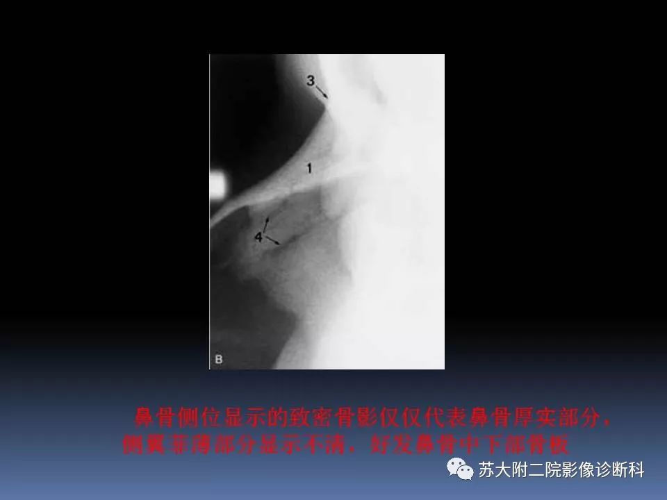 【PPT】鼻骨骨折影像诊断误区-18