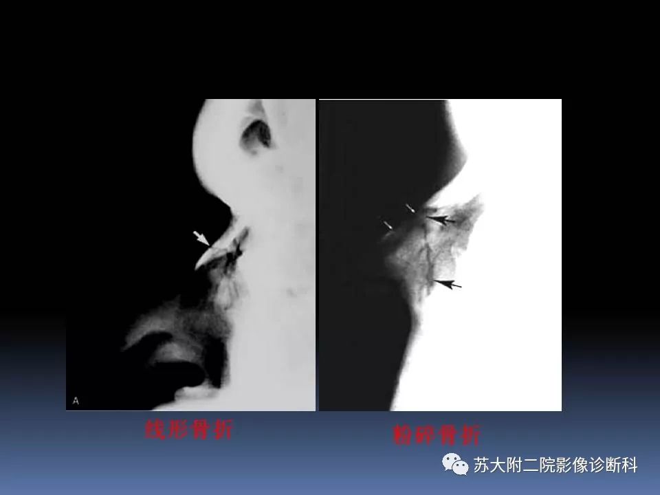 【PPT】鼻骨骨折影像诊断误区-19