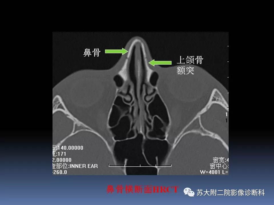 【PPT】鼻骨骨折影像诊断误区-20