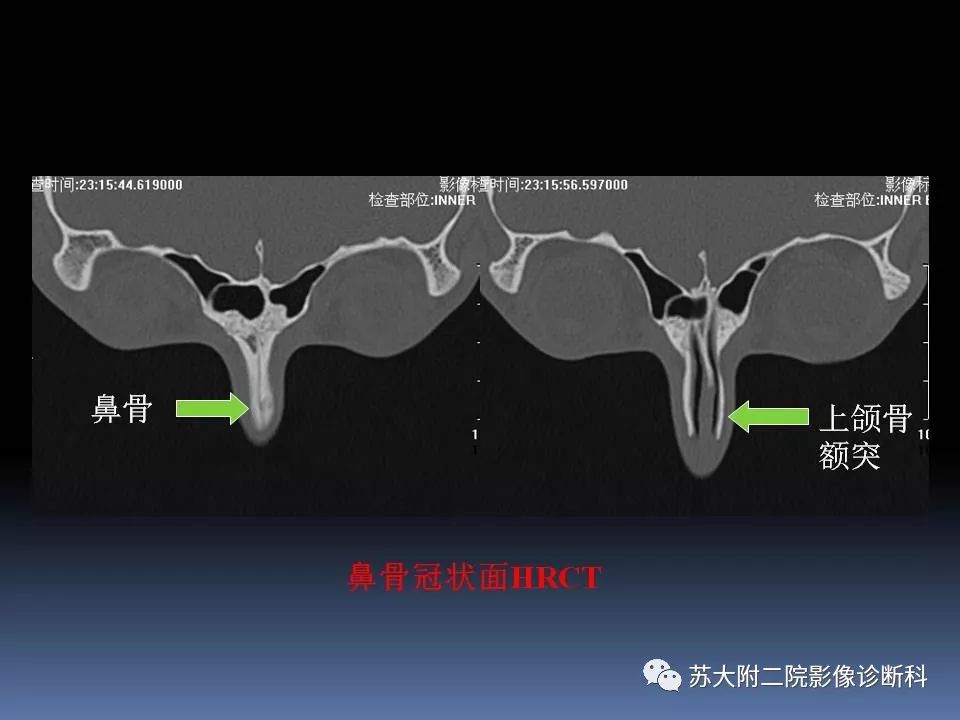 【PPT】鼻骨骨折影像诊断误区-21