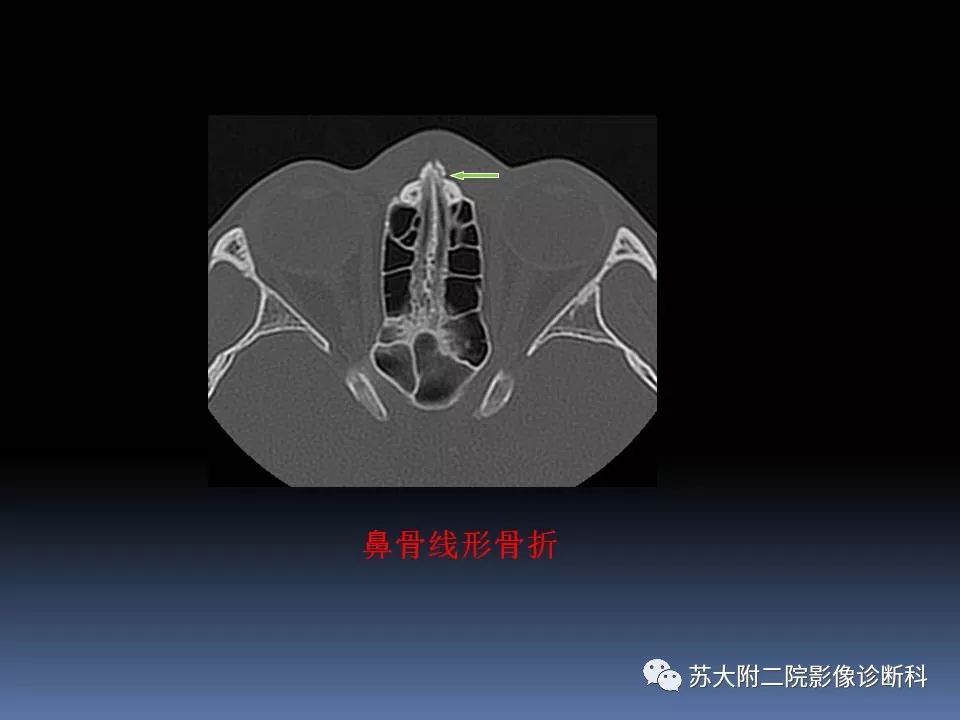 【PPT】鼻骨骨折影像诊断误区-24
