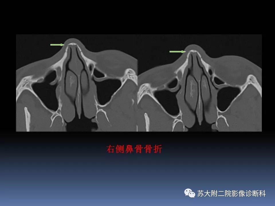 【PPT】鼻骨骨折影像诊断误区-26